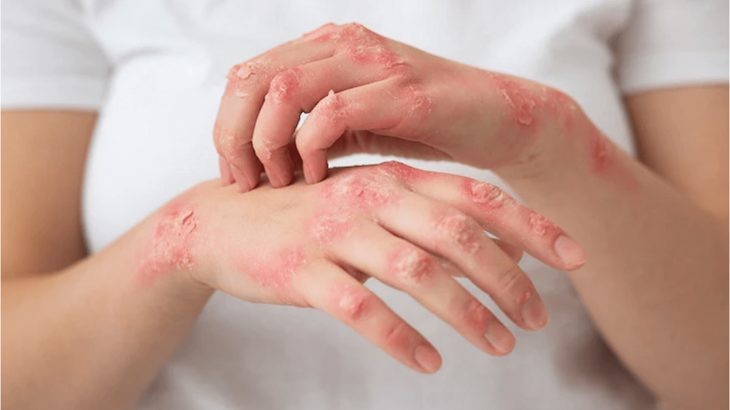 reiki psoriasi
